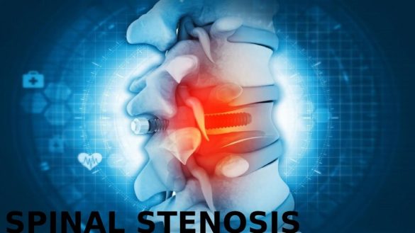 what-treatments-are-available-for-spinal-stenosis